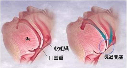 体位療法のメカニズム